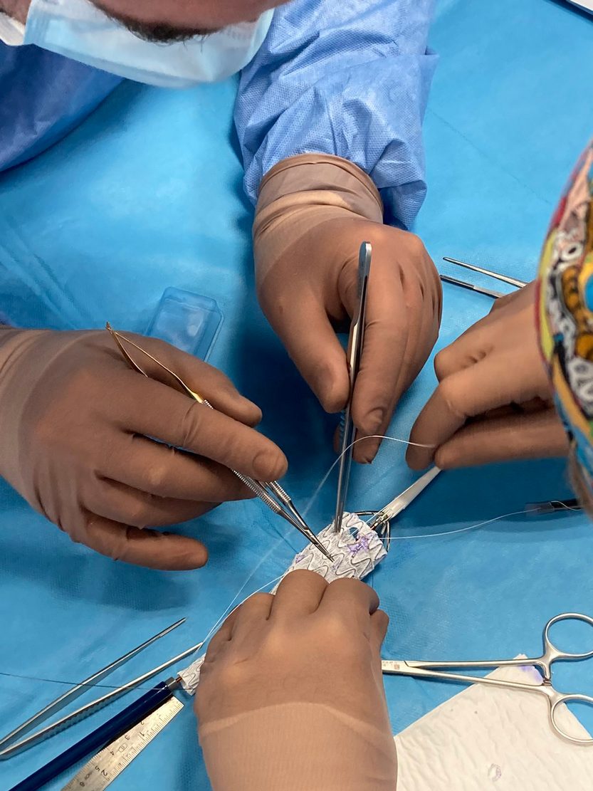 Съдови хирурзи от ,Сърце и Мозък' спасиха пациент, като извършиха първата в България имплантация на фенестрирана ендопротеза по спешност